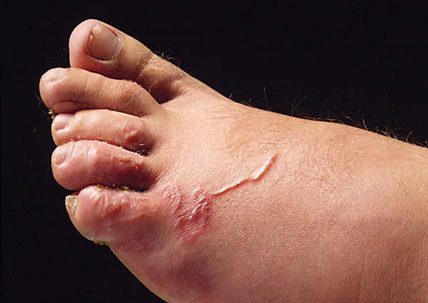 larva-migrans: Human, foot. The foot is markedly edematous, and contains a raised, thin, red, serpiginous tract.